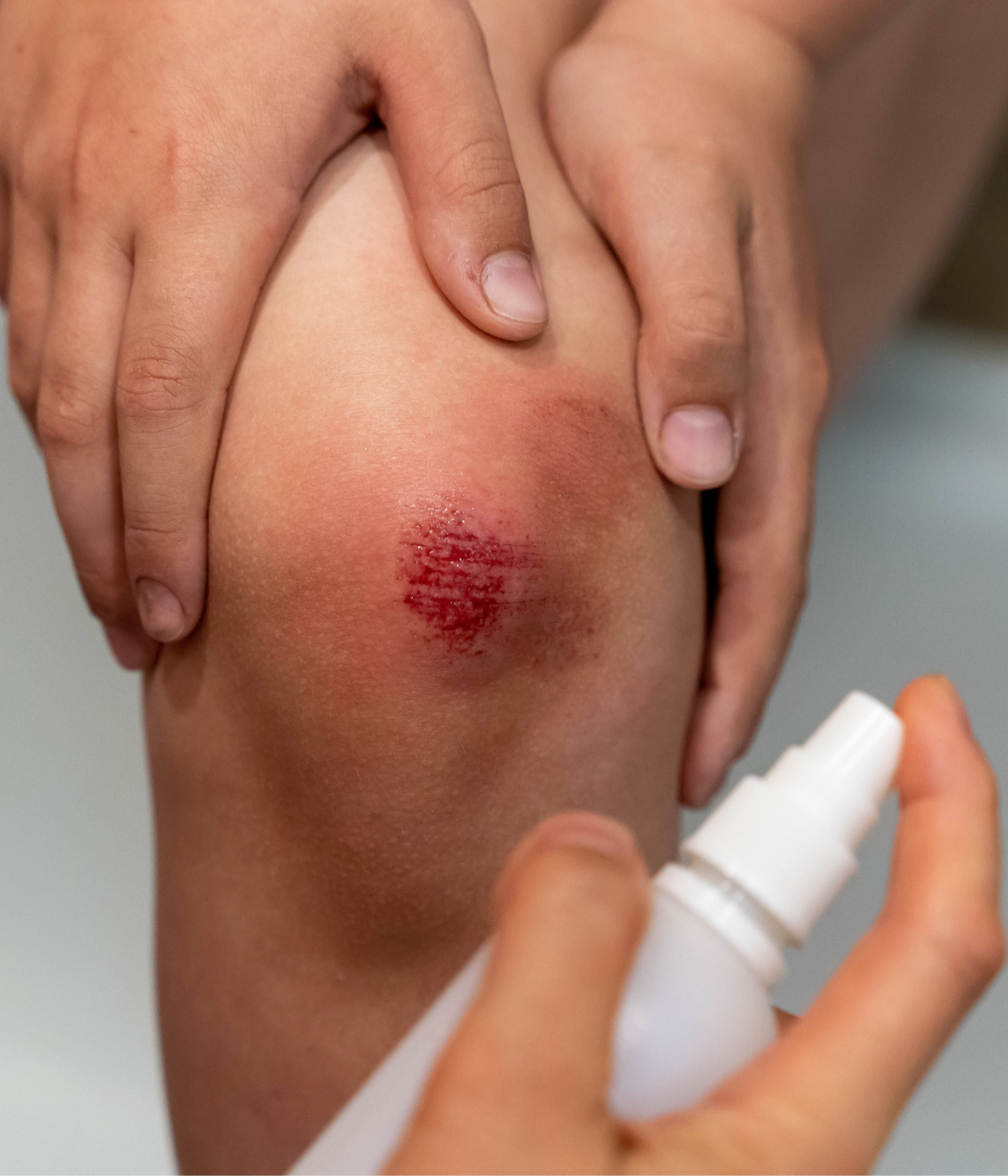 cicatriz reciente en la rodilla